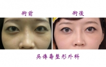 雙眼皮及矽膠隆鼻手術實例