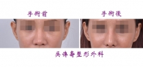 韓式隆鼻手術實例