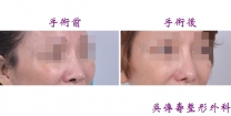 矽膠改韓式隆鼻實例