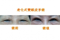 老化性雙眼皮手術