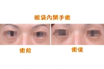 眼袋內開手術