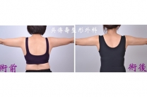 手臂z波超音波溶脂