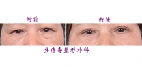 老化眼皮手術實例