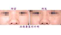 日式隆鼻手術實例