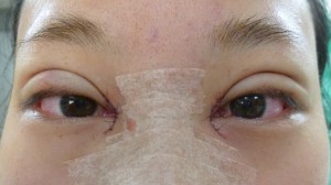 隆鼻術後會以膠帶固定壓迫，降低腫脹情形；眼頭及隆鼻縫線約5-7天拆線
